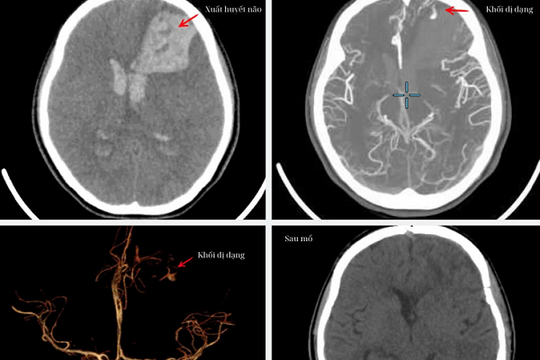 Cơn ác mộng trong phòng tắm: Cứu sống nữ sinh 16 tuổi hôn mê do xuất huyết não