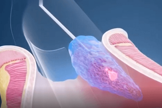 Cắt trĩ bằng laser: 30 phút thoát khỏi nỗi ám ảnh hàng năm trời