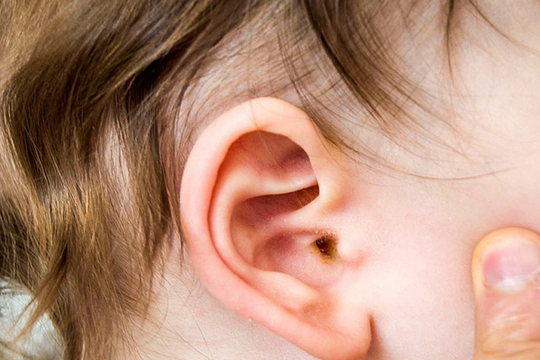 Nhiều trẻ bị thủng màng nhĩ vì một thói quen phổ biến của cha mẹ