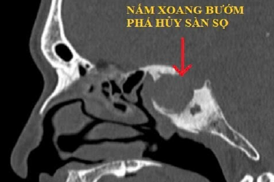 Sự thật 'rùng mình' về ca bệnh nấm xoang bướm suýt gây mù tại Cần Thơ