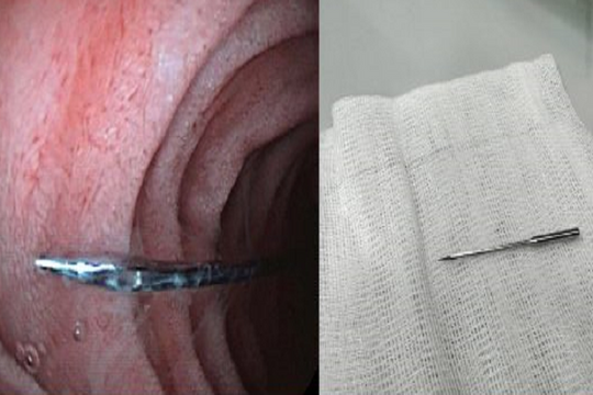 Bé trai suýt chết oan vì cây kim may: Giải cứu trong 10 phút