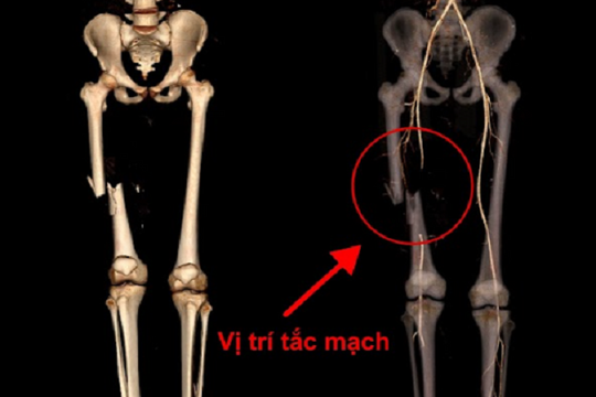 Bác sĩ xuyên đêm cứu đôi chân nam sinh 17 tuổi