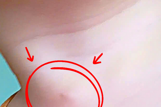 Hiểm họa từ lỗ nhỏ trên cổ trẻ: Cảnh báo rò khe mang bẩm sinh