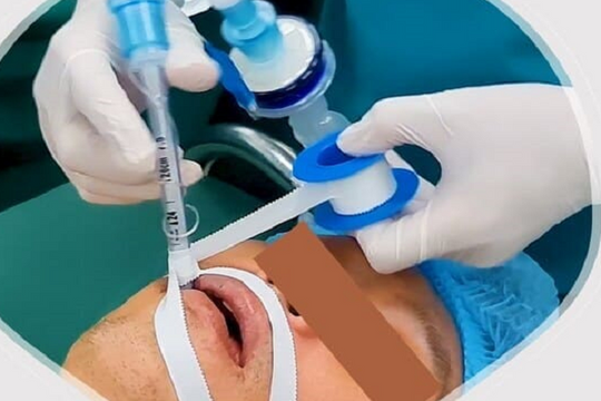 Mở khí quản cứu sống, vì sao nhiều bệnh nhân mắc rối loạn nuốt?