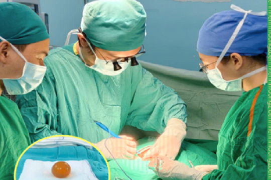 “Quái vật” polymer gây tắc ruột trẻ 18 tháng: Hiểm họa hạt nở đồ chơi