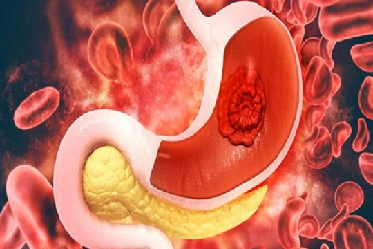 Xuất huyết tiêu hóa ở người trẻ: Báo động đỏ từ phòng nội soi