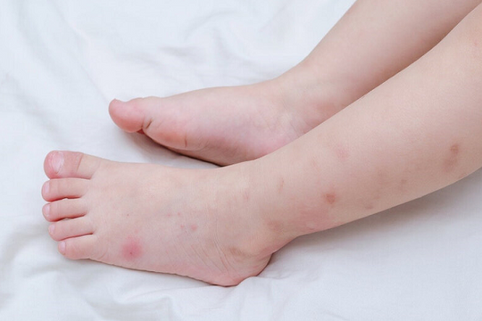 Tử thần 24 giờ: Não mô cầu có thể cướp mạng trẻ chỉ sau một cơn sốt