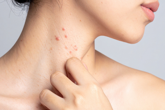 Hệ miễn dịch “phản chủ”: Cảnh báo và cách kiểm soát lupus