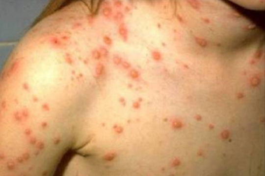 Thủy đậu lây “thần tốc”: Vì sao 90% người phơi nhiễm đều mắc bệnh?