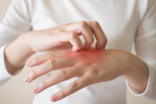Dị ứng với nước: Căn bệnh hiếm khiến việc tắm cũng thành nỗi ám ảnh