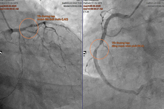 Lần đầu đặt stent tự tiêu cứu bệnh nhân nhồi máu cơ tim tại ĐBSCL