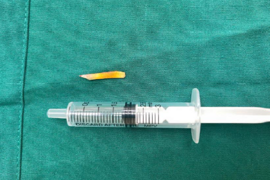 Cụ bà 104 tuổi ở Vĩnh Long thoát chết sau ca mổ lấy mảnh gỗ đâm thủng ruột non