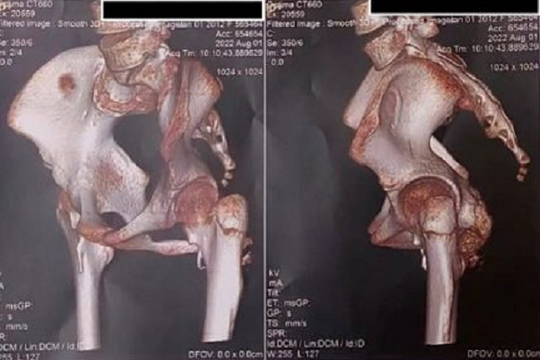 TP.HCM: Bé gái 12 tuổi suýt bị ‘hóa đá’ toàn thân vì một ca mổ không cần thiết