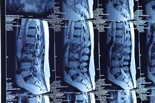 Tin mũi tiêm giảm đau, người đàn ông ở TP.HCM suýt liệt vì nhiễm trùng cột sống