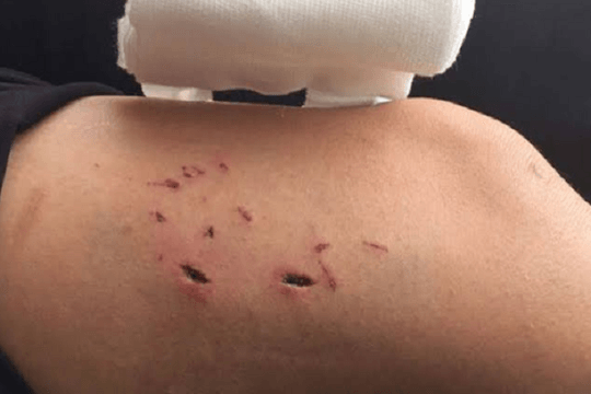 Bị chó cắn đi ‘lấy nọc’, người đàn ông tử vong vì bệnh dại