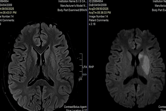 AI và MRI 3T mở rộng ‘cửa sổ vàng’ đột quỵ: Thay đổi cách tiếp cận hàng nghìn bệnh nhân