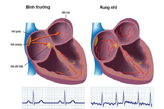 Rung nhĩ: Hai đột phá điều trị đang thay đổi cách phòng ngừa đột quỵ
