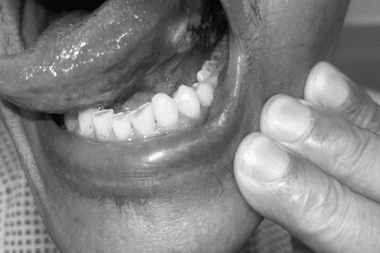 Ung thư lưỡi không còn là ‘án tử’: Kĩ thuật mới giúp giữ lại khả năng ăn nói