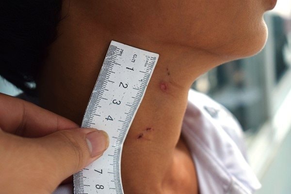 Thiếu niên 14 tuổi bị 'cha dượng' đốt bộ phận sinh dục: Tổn thương nghiêm trọng về thể chất và tâm lý
