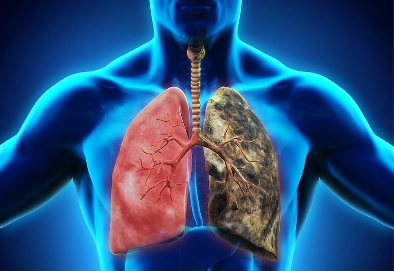 Tầm soát ung thư phổi bằng chụp CT liều thấp tăng cơ hội sống cho bệnh nhân 