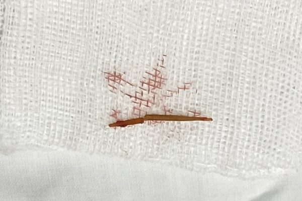 Tưởng mắc bệnh ung thư, thiếu niên 17 tuổi bất ngờ phát hiện bị hóc xương cá