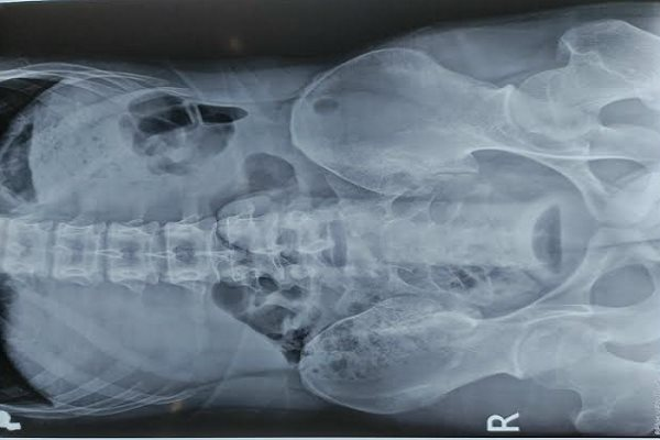 Tự 'tìm cảm giác lạ', nam thanh niên bị kẹt dương vật giả dài 25cm trong trực tràng 