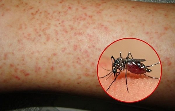 3 ca tử vong, Hà Nội sắp bước vào đỉnh dịch sốt xuất huyết
