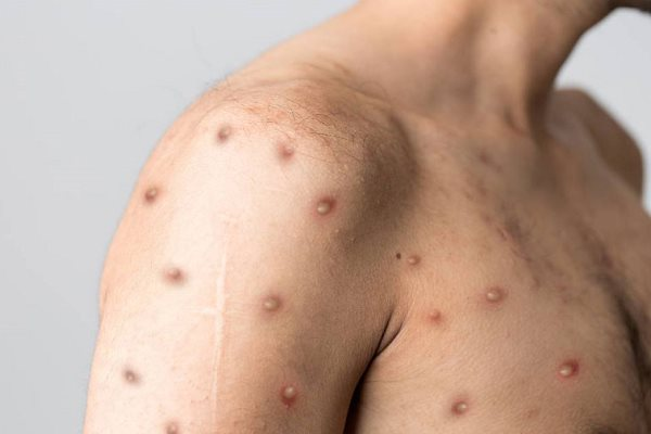 Cô gái tiếp xúc gần bệnh nhân ở Đồng Nai bị dương tính với đậu mùa khỉ