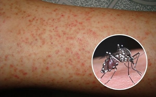 Việt Nam sắp có vắc xin phòng bệnh sốt xuất huyết