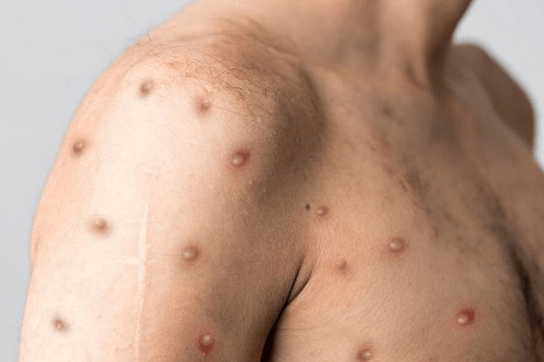 TP.HCM: Một bệnh nhân mắc bệnh đậu mùa khỉ đã tử vong