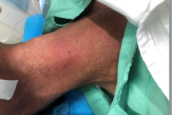 Nam thanh niên bị xương cá đâm trong cổ gần lòi ra ngoài