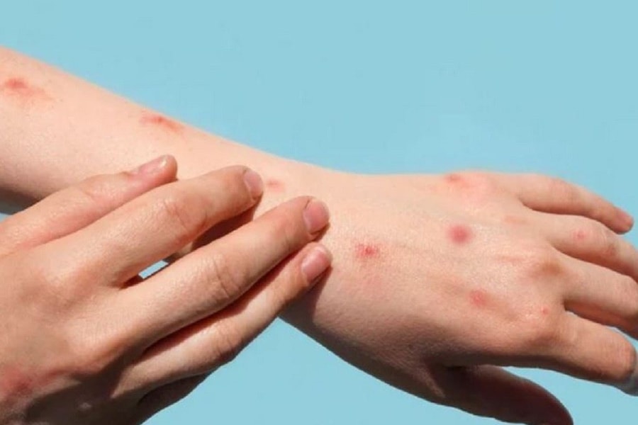 Việt Nam ghi nhận 56 ca đậu mùa khỉ, Bộ Y tế yêu cầu giám sát chặt chẽ nguồn lây