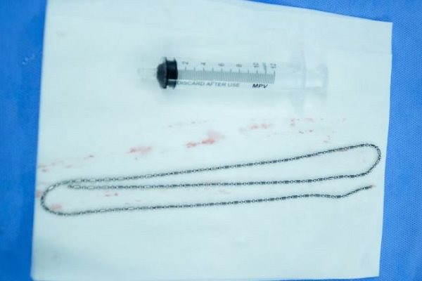 Nam sinh nhét “vật lạ” dài 60cm vào niệu đạo để tự sướng phải nhập viện cấp cứu