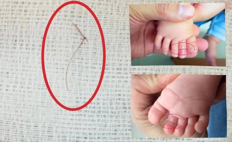Bé gái 4 tháng tuổi suýt mất ngón chân vì sợi tóc