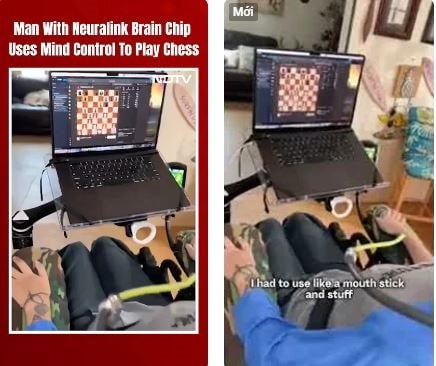 Video bệnh nhân liệt tứ chi được Neuralink cấy ghép chip não chơi cờ online