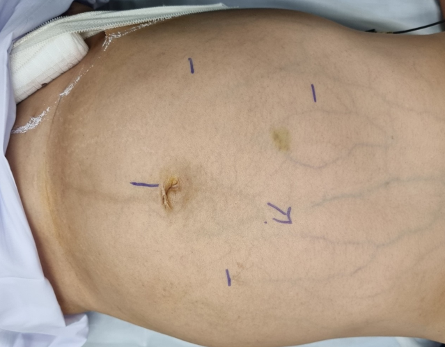 Cứu người phụ nữ mang khối u gan khổng lồ nặng hơn 5kg