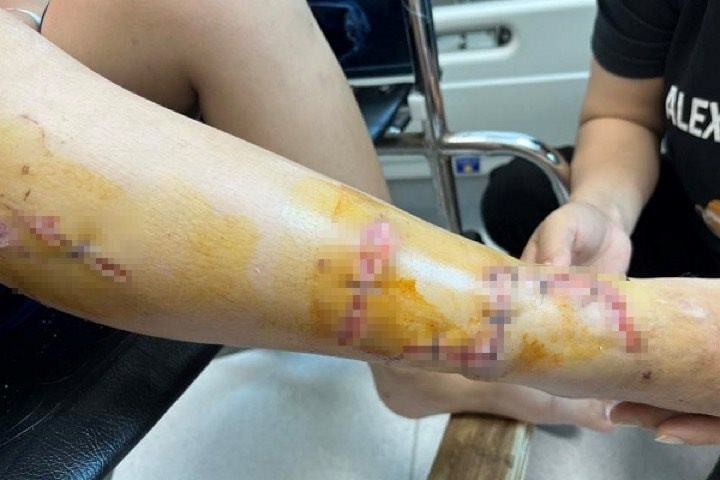 Bé trai 10 tuổi bị kính bể nuôi cá cảnh cắt nát chân