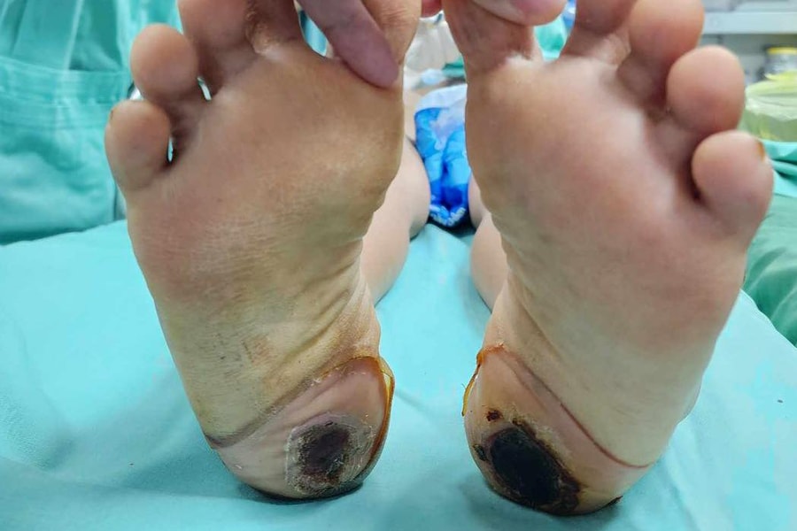 Tự điều trị đau cột sống bằng phương pháp dân gian, người phụ nữ suýt bị liệt vĩnh viễn