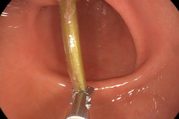 Hy hữu: Ăn lẩu, người phụ nữ bị nhánh cây sả dài gần 4cm cắm sâu vào dạ dày