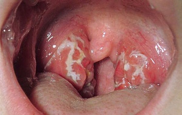 Bắc Giang khẩn trương rà soát người tiếp xúc với ca nhiễm bệnh bạch hầu
