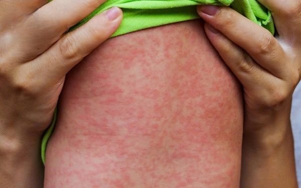 Bốn biện pháp trọng tâm phòng chống dịch bệnh sởi