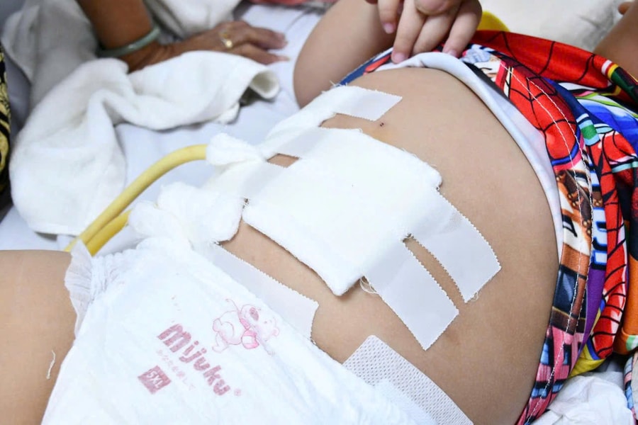 Cấp cứu thành công bé trai 2 tuổi bị xương cá điêu hồng gây thủng ruột