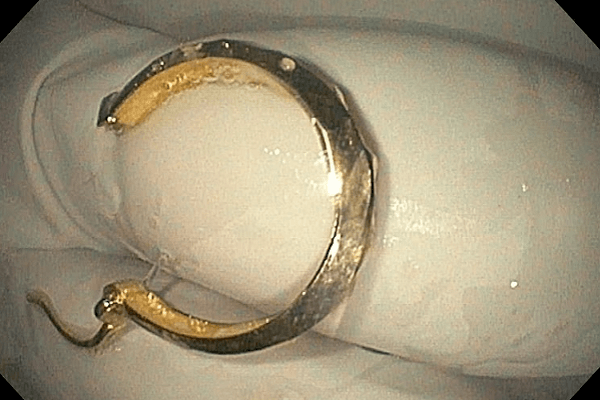 Người phụ nữ tá hỏa khi phát hiện khuyên tai trong bụng con gái 8 tháng tuổi