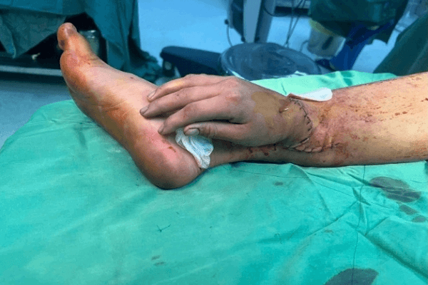 Ca phẫu thuật đặc biệt để cứu bàn tay thai phụ