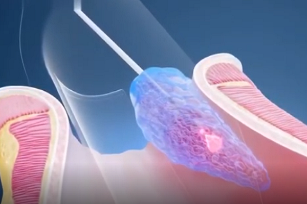 Cắt trĩ bằng laser: 30 phút thoát khỏi nỗi ám ảnh hàng năm trời