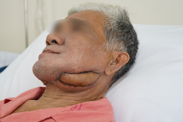 Chợ Rẫy tái sinh gương mặt biến dạng suốt 6 năm bằng vi phẫu