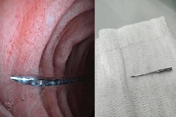 Bé trai suýt chết oan vì cây kim may: Giải cứu trong 10 phút