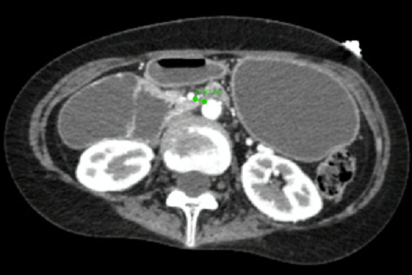 Bão giáp kích hoạt trong phòng mổ, nữ bệnh nhân trẻ nguy kịch