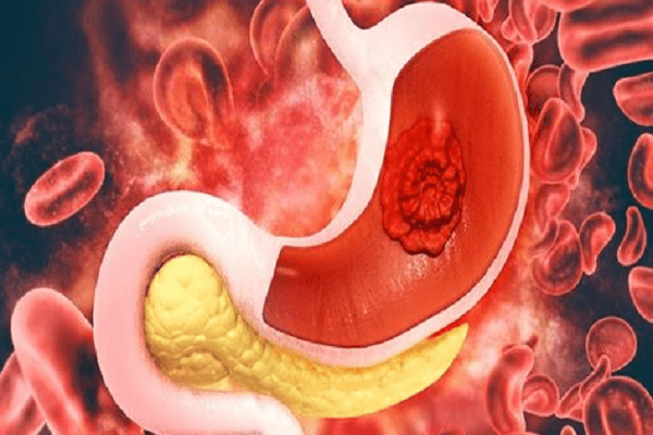 Xuất huyết tiêu hóa ở người trẻ: Báo động đỏ từ phòng nội soi
