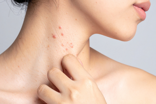 Hệ miễn dịch “phản chủ”: Cảnh báo và cách kiểm soát lupus